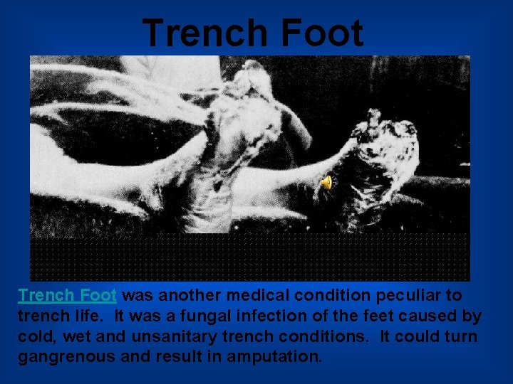 Trench Foot was another medical condition peculiar to trench life. It was a fungal