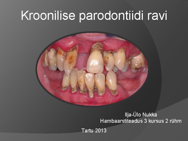 Kroonilise parodontiidi ravi Ilja-Ülo Nukka Hambaarstiteadus 3 kursus 2 rühm Tartu 2013 