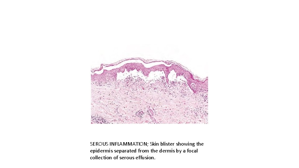 SEROUS INFLAMMATION; Skin blister showing the epidermis separated from the dermis by a focal