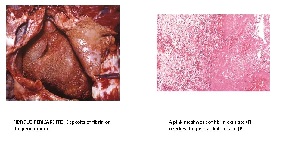 FIBROUS PERICARDITIS; Deposits of fibrin on the pericardium. A pink meshwork of fibrin exudate