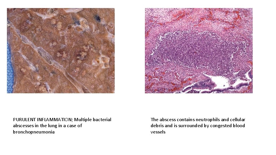 PURULENT INFLAMMATION; Multiple bacterial abscesses in the lung in a case of bronchopneumonia The