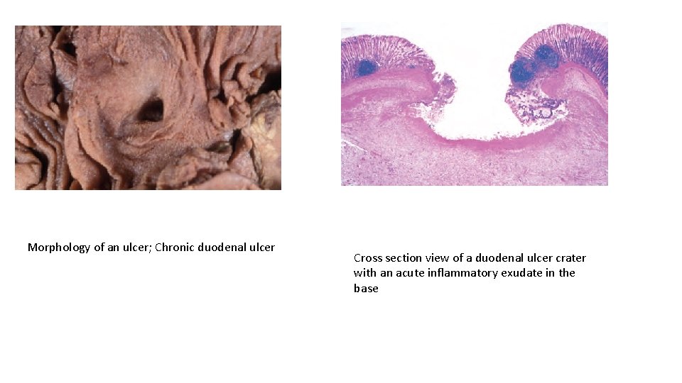 Morphology of an ulcer; Chronic duodenal ulcer Cross section view of a duodenal ulcer