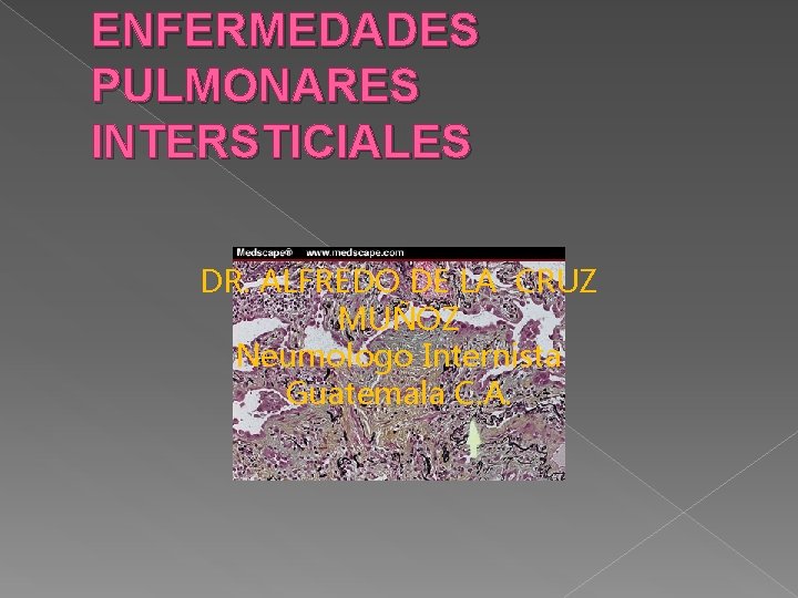 ENFERMEDADES PULMONARES INTERSTICIALES DR. ALFREDO DE LA CRUZ MUÑOZ Neumologo Internista Guatemala C. A.