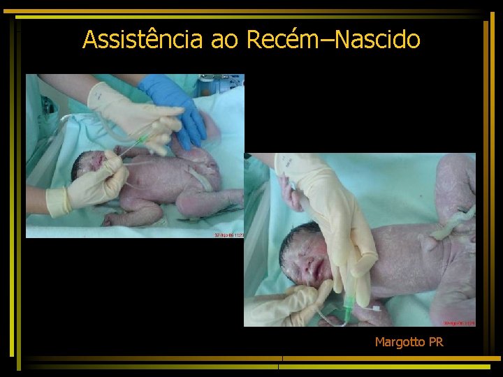 Assistência ao Recém–Nascido Margotto PR 