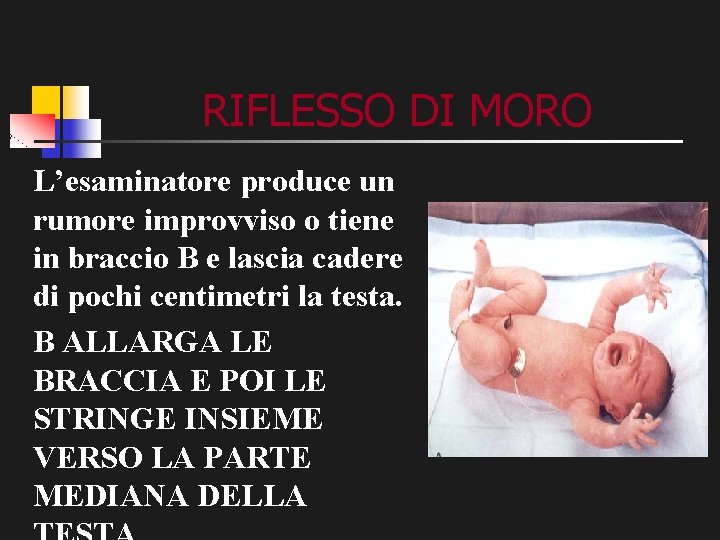 RIFLESSO DI MORO L’esaminatore produce un rumore improvviso o tiene in braccio B e