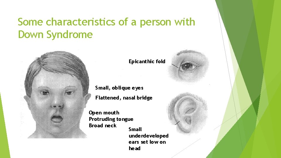 Some characteristics of a person with Down Syndrome Epicanthic fold Small, oblique eyes Flattened,