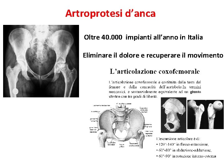 Artroprotesi d’anca Oltre 40. 000 impianti all’anno in Italia Eliminare il dolore e recuperare