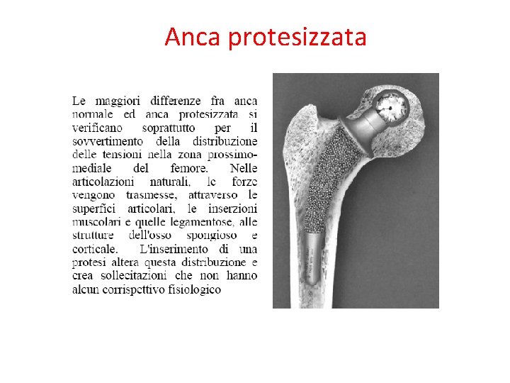 Anca protesizzata 