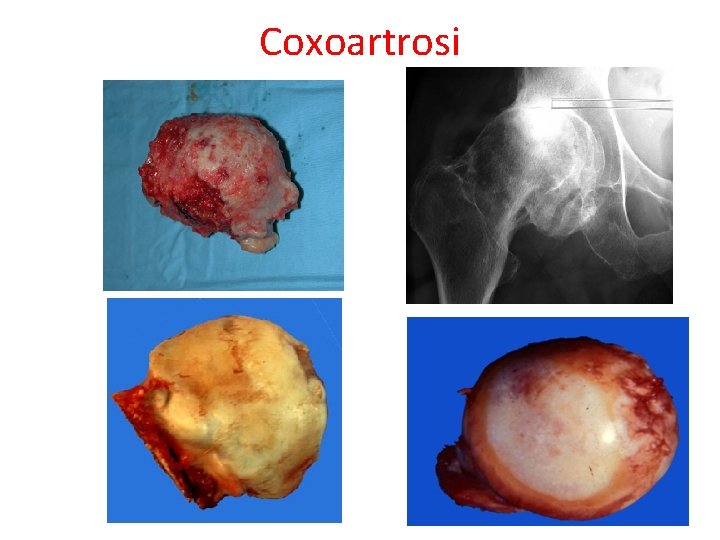 Coxoartrosi 