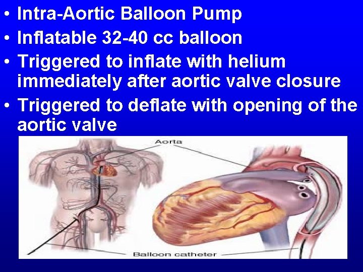 • Intra-Aortic Balloon Pump • Inflatable 32 -40 cc balloon • Triggered to • Intra-Aortic Balloon Pump • Inflatable 32 -40 cc balloon • Triggered to