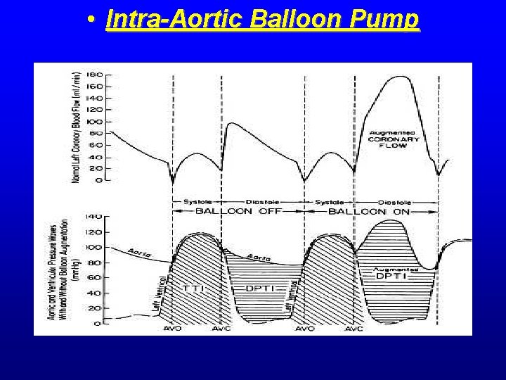 • Intra-Aortic Balloon Pump • Intra-Aortic Balloon Pump