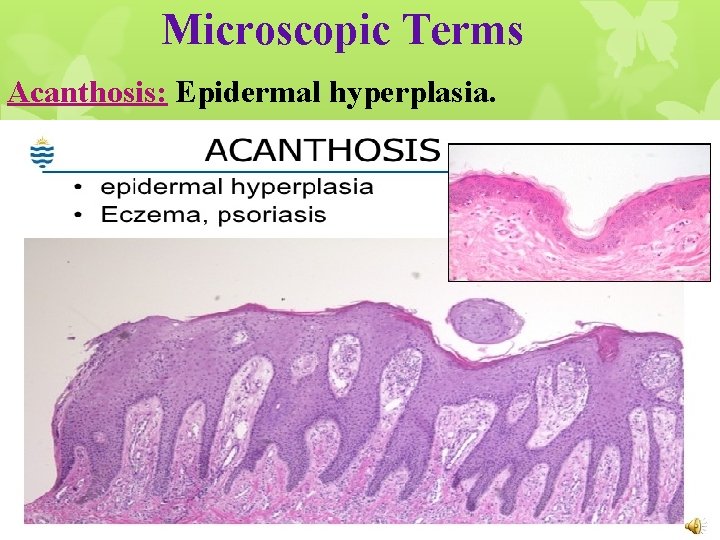 Microscopic Terms Acanthosis: Epidermal hyperplasia. 