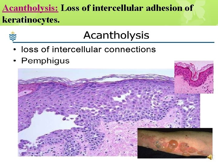 Acantholysis: Loss of intercellular adhesion of keratinocytes. 