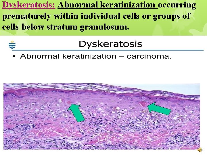 Dyskeratosis: Abnormal keratinization occurring prematurely within individual cells or groups of cells below stratum