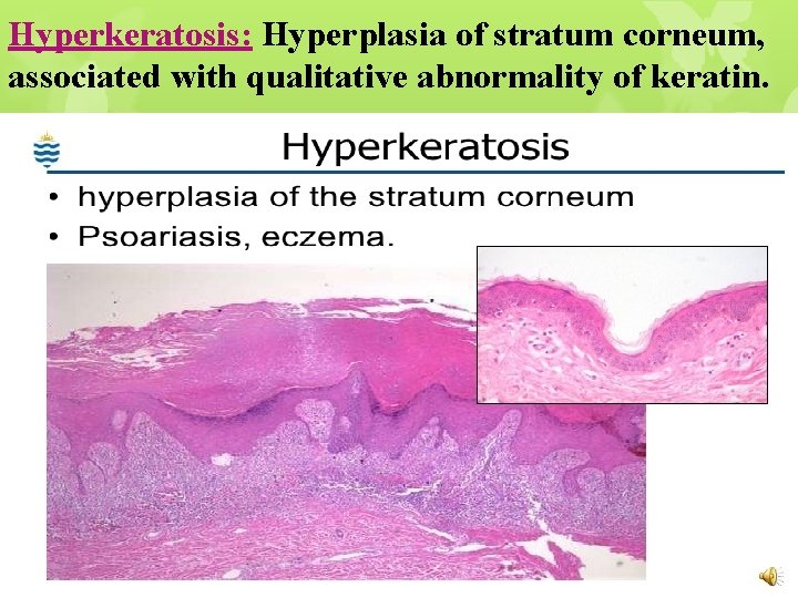 Hyperkeratosis: Hyperplasia of stratum corneum, associated with qualitative abnormality of keratin. 
