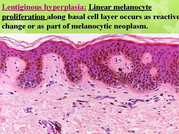 Lentiginous hyperplasia: Linear melanocyte proliferation along basal cell layer occurs as reactive change or