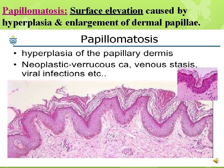 Papillomatosis: Surface elevation caused by hyperplasia & enlargement of dermal papillae. 