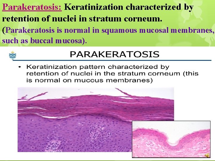 Parakeratosis: Keratinization characterized by retention of nuclei in stratum corneum. (Parakeratosis is normal in