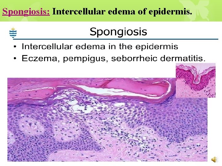 Spongiosis: Intercellular edema of epidermis. 