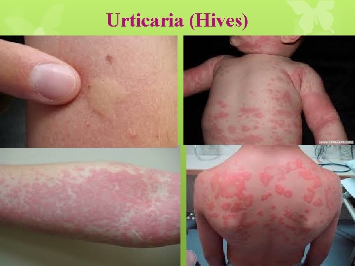 Urticaria (Hives) 