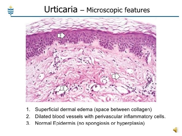  Morphology Superficial perivenular infiltrate of mononuclear cells, rare neutrophils, & sometimes eosinophils. Superficial
