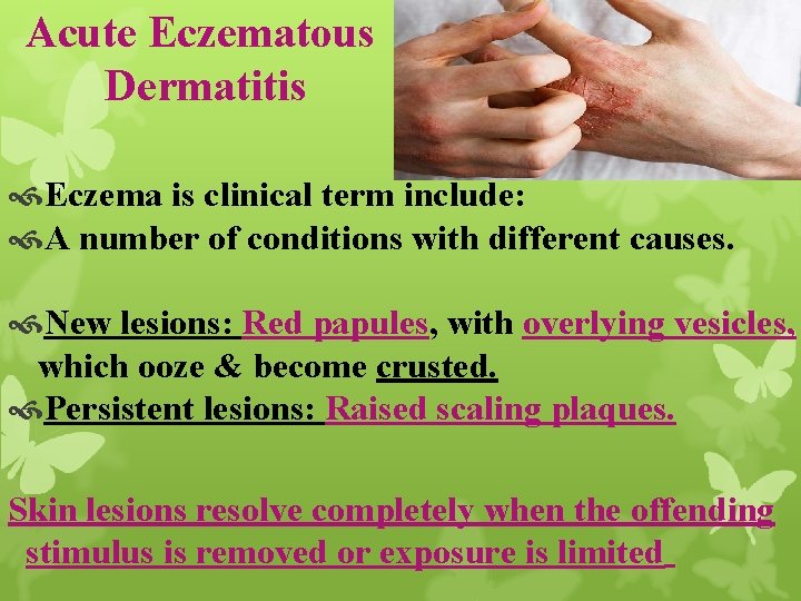 Acute Eczematous Dermatitis Eczema is clinical term include: A number of conditions with different