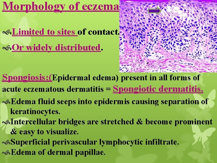Morphology of eczema: Limited to sites of contact. Or widely distributed. Spongiosis: (Epidermal edema)