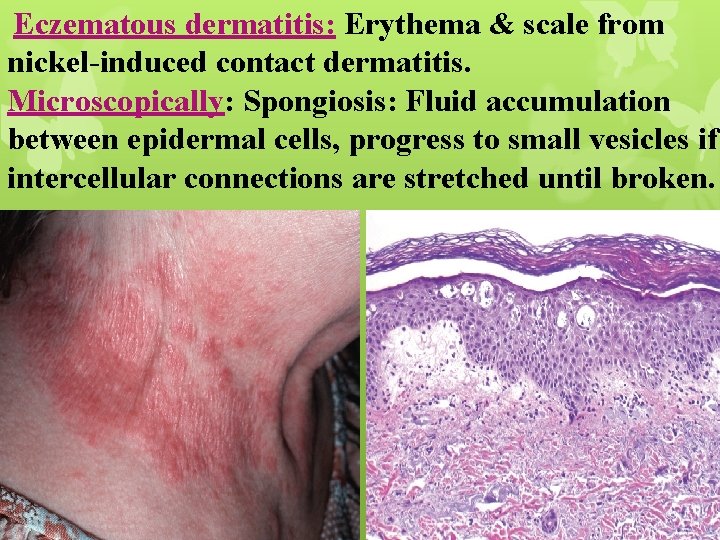Eczematous dermatitis: Erythema & scale from nickel-induced contact dermatitis. Microscopically: Spongiosis: Fluid accumulation between