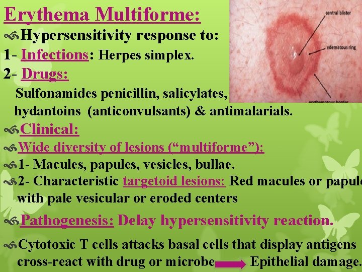 Erythema Multiforme: Hypersensitivity response to: 1 - Infections: Herpes simplex. 2 - Drugs: Sulfonamides