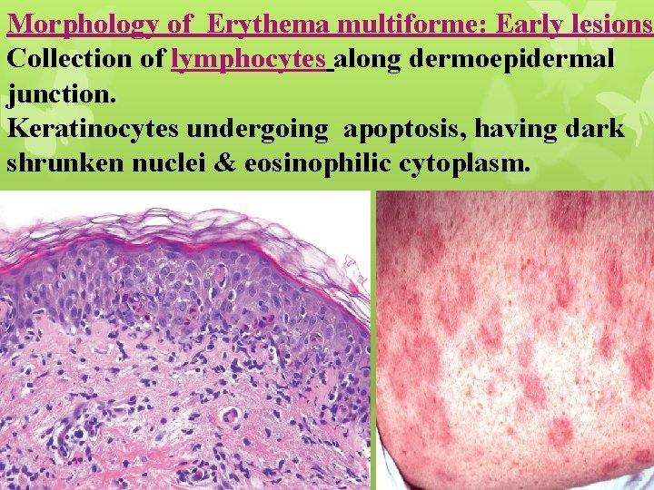 Morphology of Erythema multiforme: Early lesions Collection of lymphocytes along dermoepidermal junction. Keratinocytes undergoing