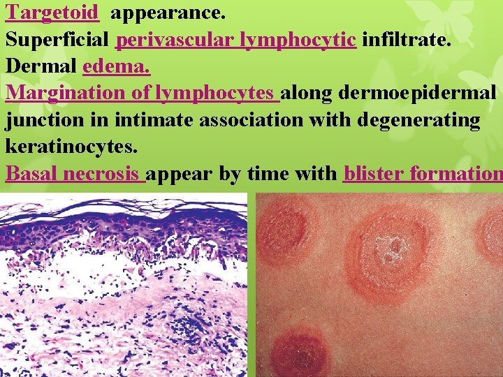 Targetoid appearance. Superficial perivascular lymphocytic infiltrate. Dermal edema. Margination of lymphocytes along dermoepidermal junction