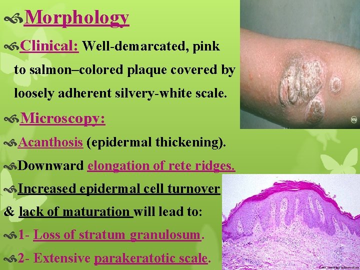  Morphology Clinical: Well-demarcated, pink to salmon–colored plaque covered by loosely adherent silvery-white scale.