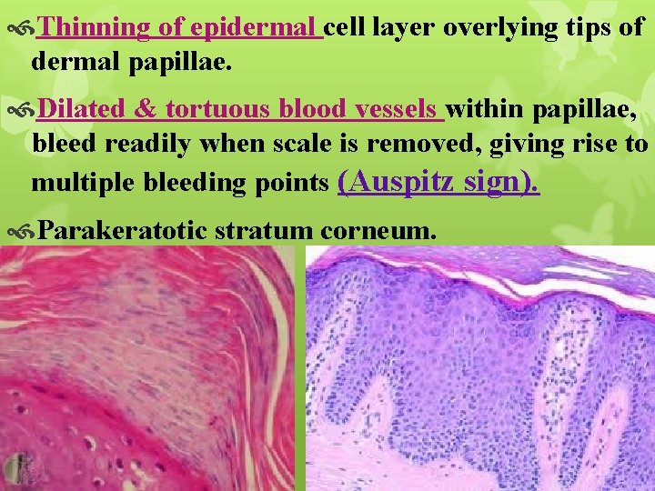  Thinning of epidermal cell layer overlying tips of dermal papillae. Dilated & tortuous