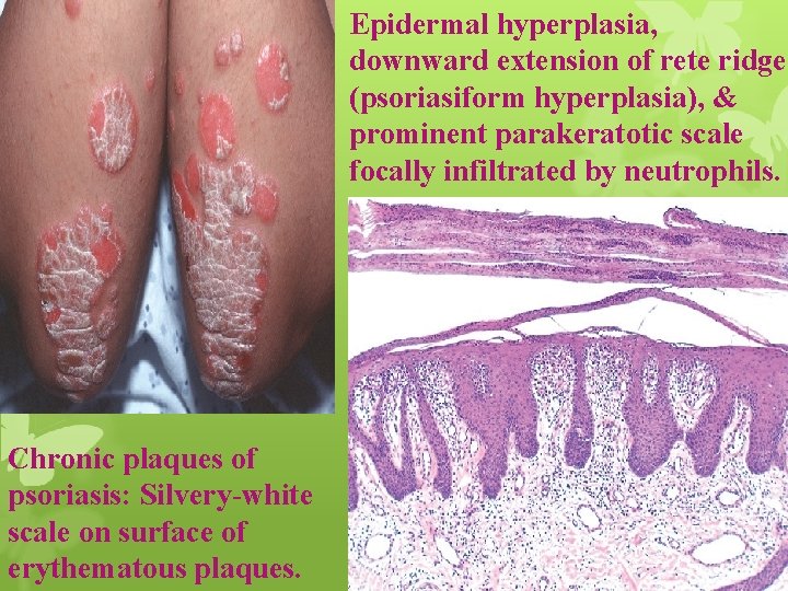 Epidermal hyperplasia, downward extension of rete ridges (psoriasiform hyperplasia), & prominent parakeratotic scale focally