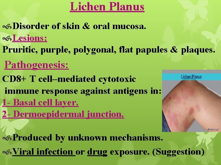 Lichen Planus Disorder of skin & oral mucosa. Lesions: Pruritic, purple, polygonal, flat papules