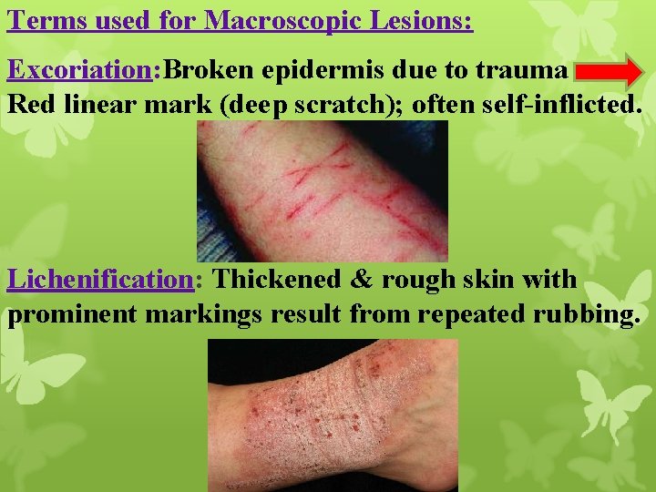 Terms used for Macroscopic Lesions: Excoriation: Broken epidermis due to trauma Red linear mark