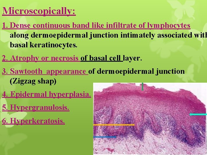 Microscopically: 1. Dense continuous band like infiltrate of lymphocytes along dermoepidermal junction intimately associated