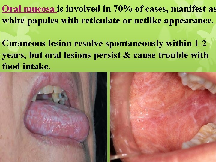 Oral mucosa is involved in 70% of cases, manifest as white papules with reticulate