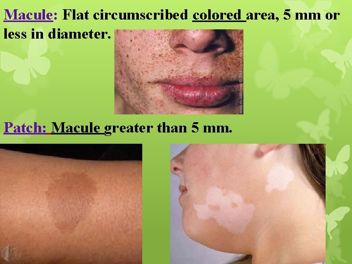 Macule: Flat circumscribed colored area, 5 mm or less in diameter. Patch: Macule greater