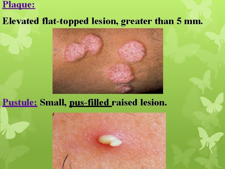 Plaque: Elevated flat-topped lesion, greater than 5 mm. Pustule: Small, pus-filled raised lesion. 