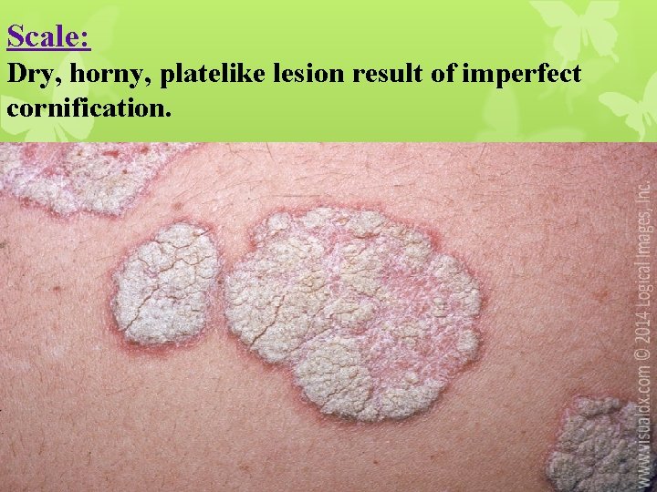 Scale: Dry, horny, platelike lesion result of imperfect cornification. 