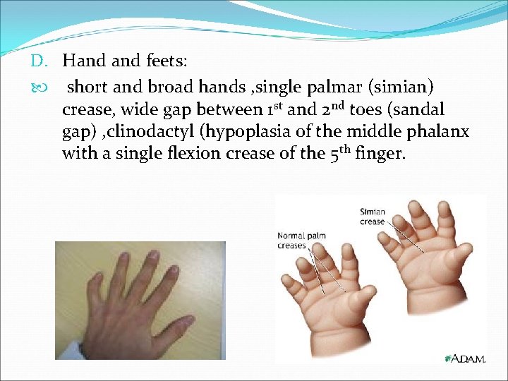 D. Hand feets: short and broad hands , single palmar (simian) crease, wide gap