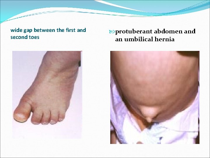 wide gap between the first and second toes protuberant abdomen and an umbilical hernia