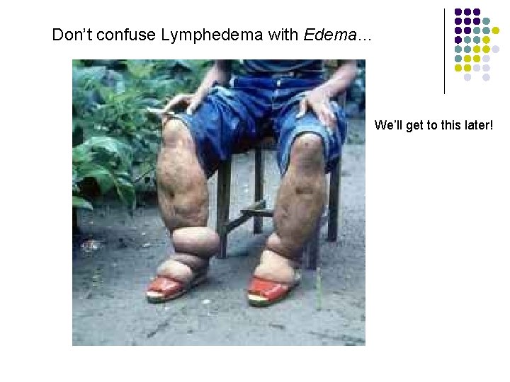 Don’t confuse Lymphedema with Edema… We’ll get to this later! 