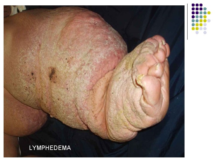 LYMPHEDEMA 