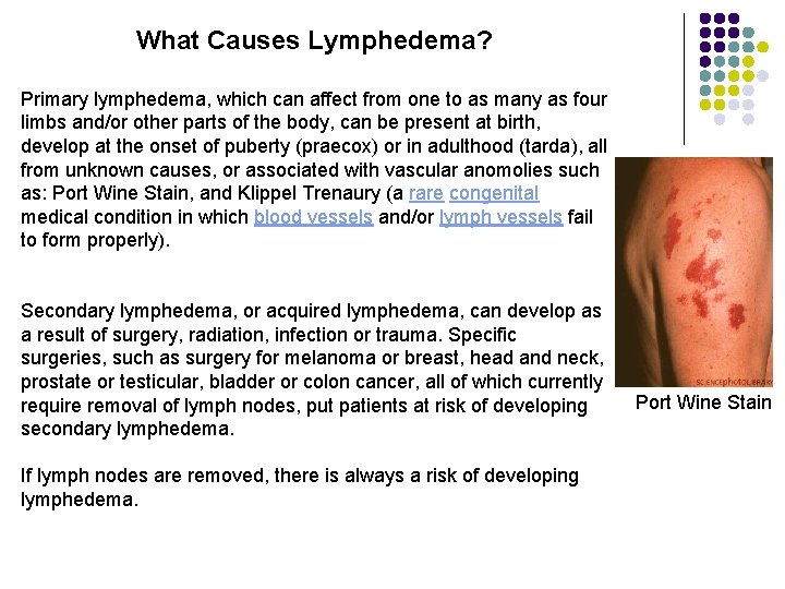 What Causes Lymphedema? Primary lymphedema, which can affect from one to as many as