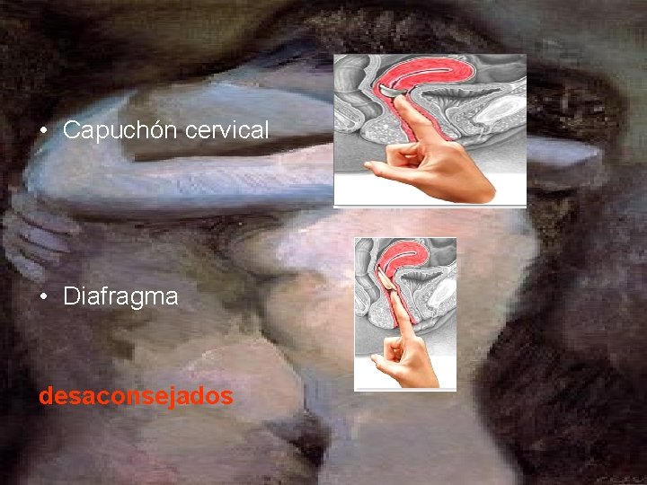  • Capuchón cervical • Diafragma desaconsejados 