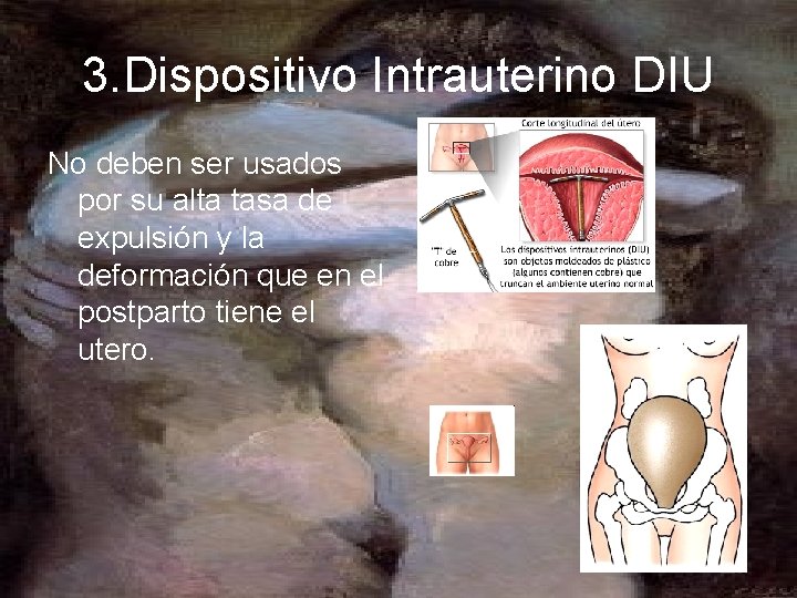 3. Dispositivo Intrauterino DIU No deben ser usados por su alta tasa de expulsión