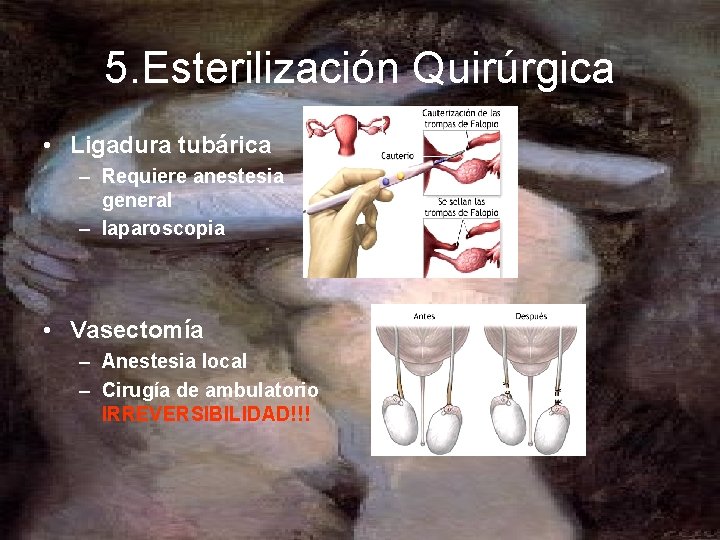 5. Esterilización Quirúrgica • Ligadura tubárica – Requiere anestesia general – laparoscopia • Vasectomía