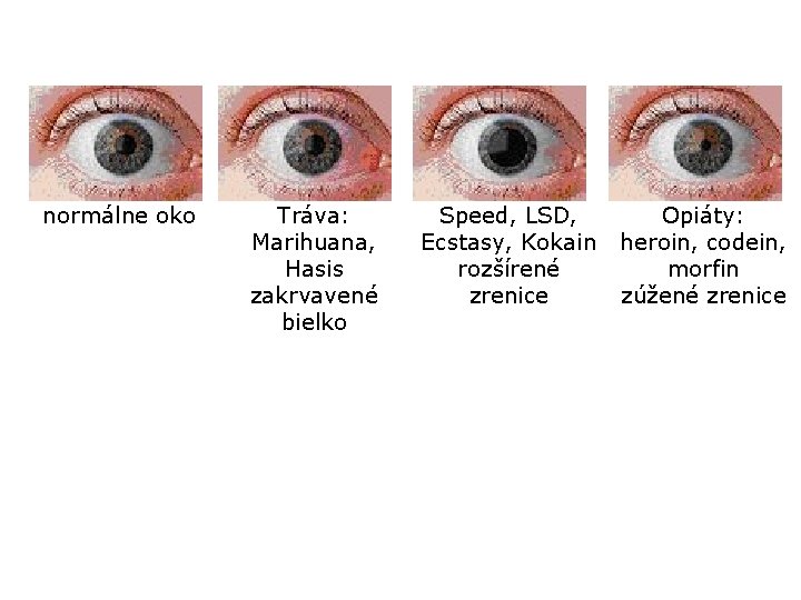 normálne oko Tráva: Marihuana, Hasis zakrvavené bielko Speed, LSD, Ecstasy, Kokain rozšírené zrenice Opiáty: